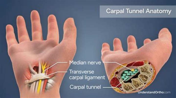 Where does your arm hurt if you have carpal tunnel?