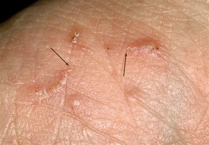 Where is scabies found on the body?