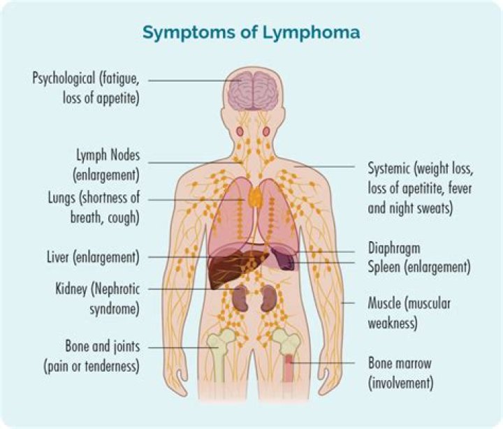 Where is the pain with lymphoma?