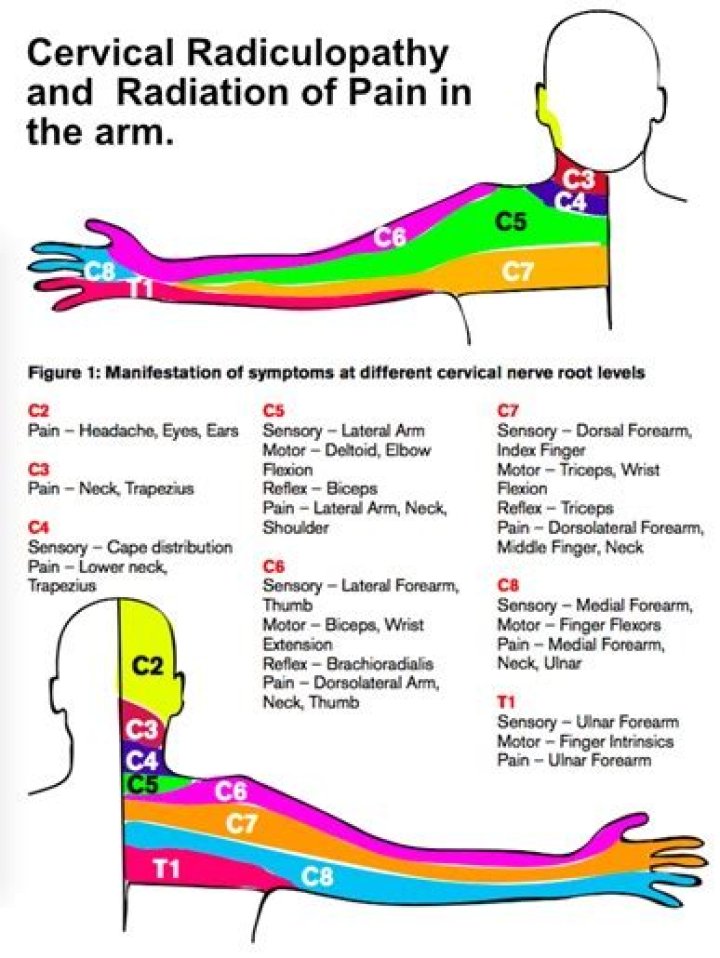 Which fingers are affected by cervical radiculopathy?