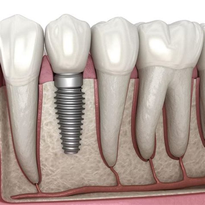Which is better a crown or implant?