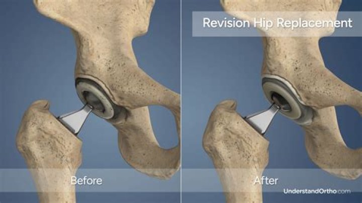 Which is worse hip replacement or rotator cuff surgery?