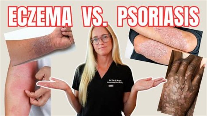Which is worse psoriasis or eczema?