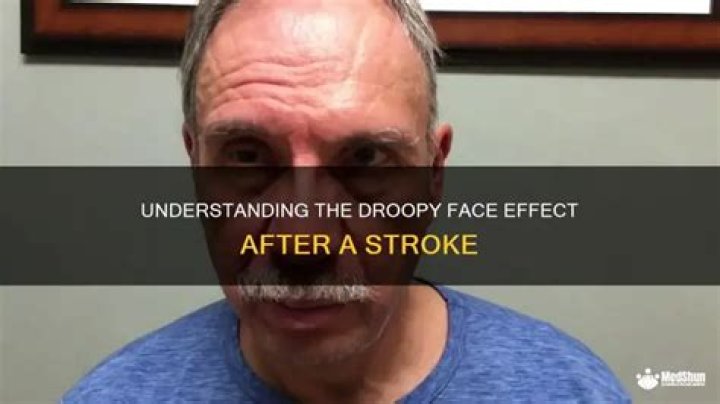 Which side of the face droops in a stroke?