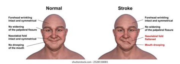 Which side of your face droops in a stroke?