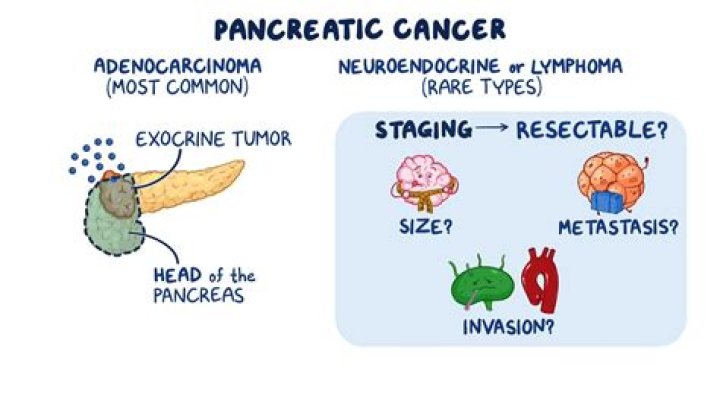 Who gets adenocarcinoma?
