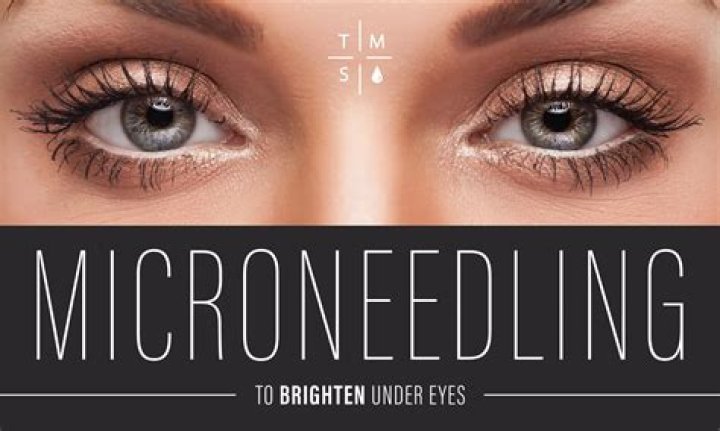 Who should not have microneedling?