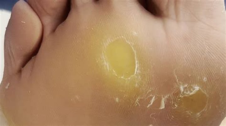 Why are calluses yellow?