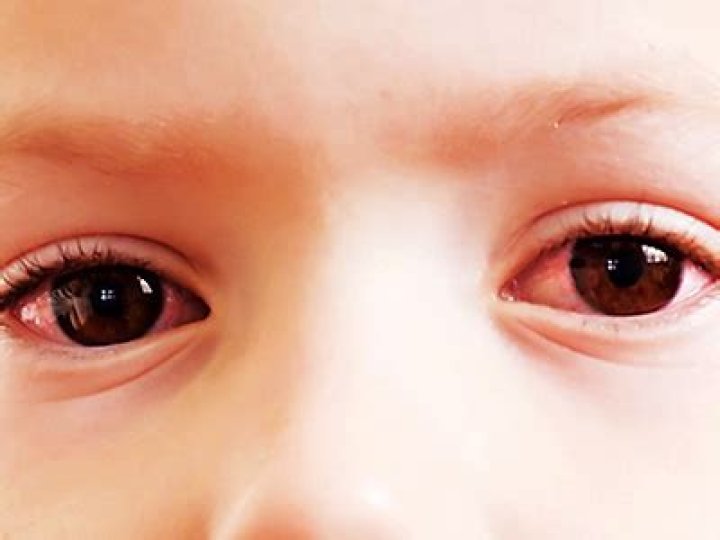 Why are my child's eyes red underneath?