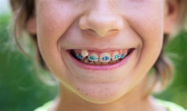 Why do 8 year olds need braces?