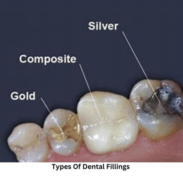 Why do dentists still use silver fillings?