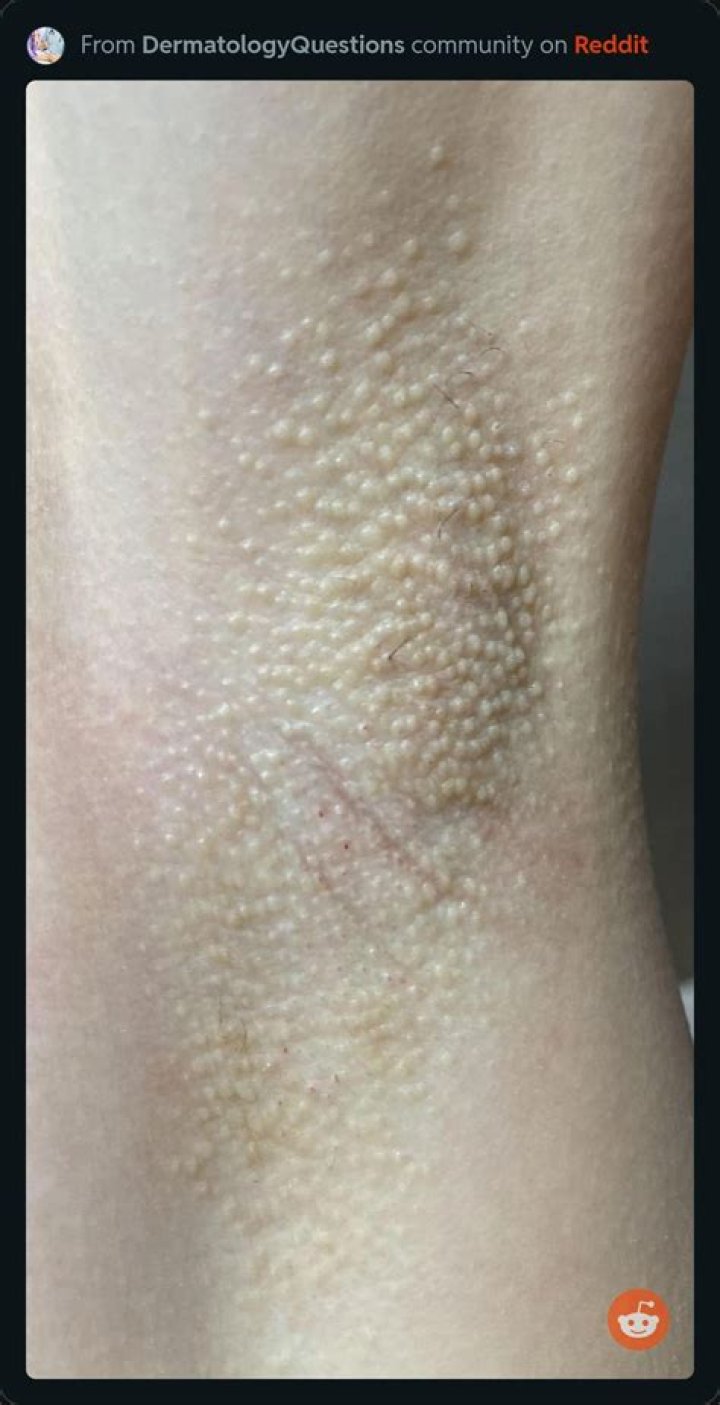 Why do I get bumps after sugaring?