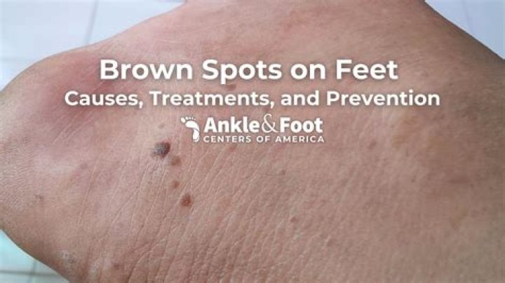 Why do I have spots on the bottom of my feet?