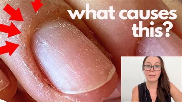 Why do my fingers itch after getting a gel manicure?