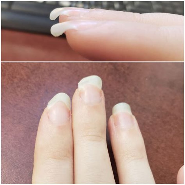 Why do my nails grow curved down?