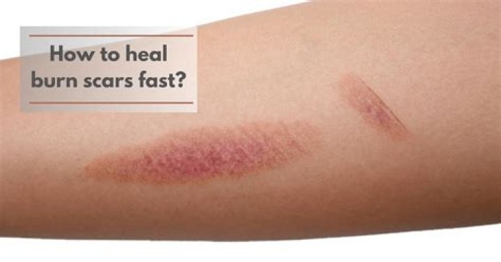 Why do my scars take so long to heal?