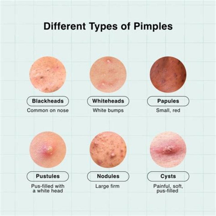 Why do pimples hurt when popped?