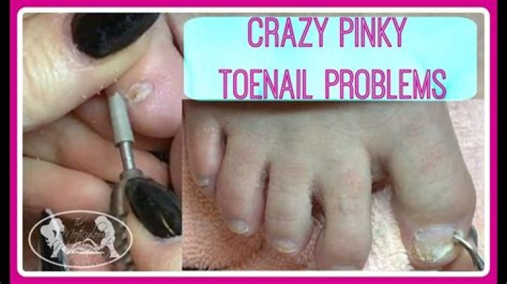 Why do pinky toe nails turn black?