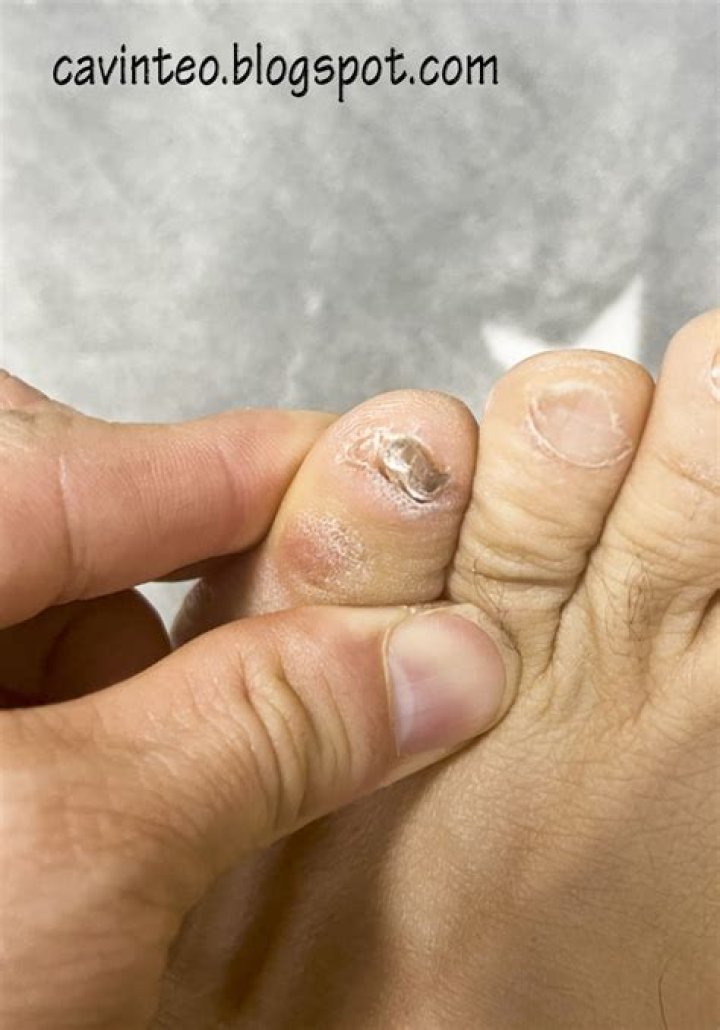 Why do pinky toenails fall off?