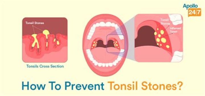 Why do tonsil stones smell?