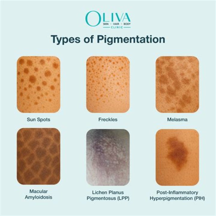 Why does hyperpigmentation take so long to fade?