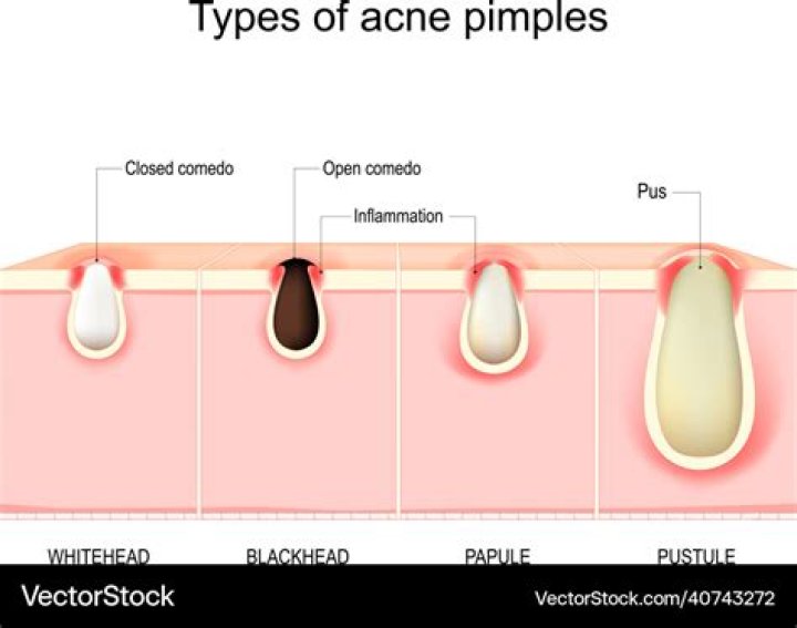 Why does pus from pimples smell?