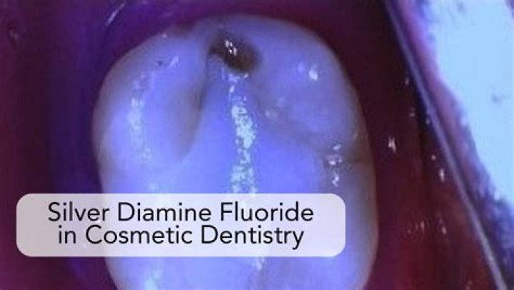 Why does silver diamine fluoride turn teeth black?