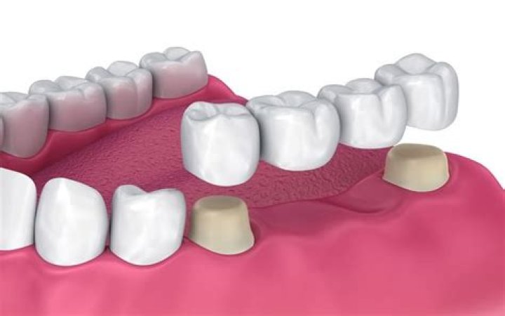 Why is a doctor prefer bridge over implant?