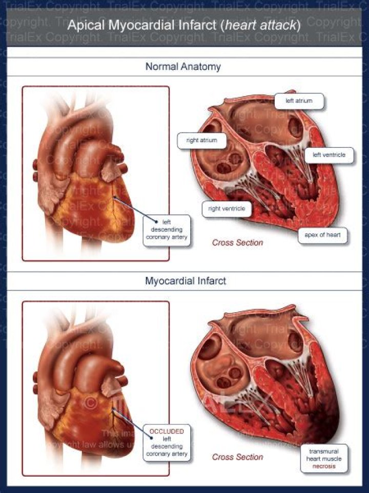 Why is clopidogrel given in myocardial infarction?