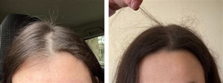 Why is my hair breaking at the top?