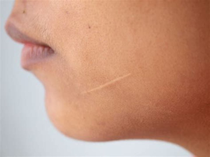 Why is my scar white and raised?