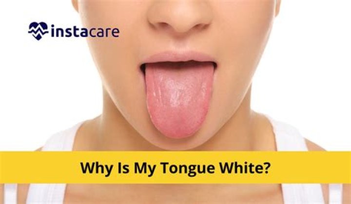 Why is my tongue so white?