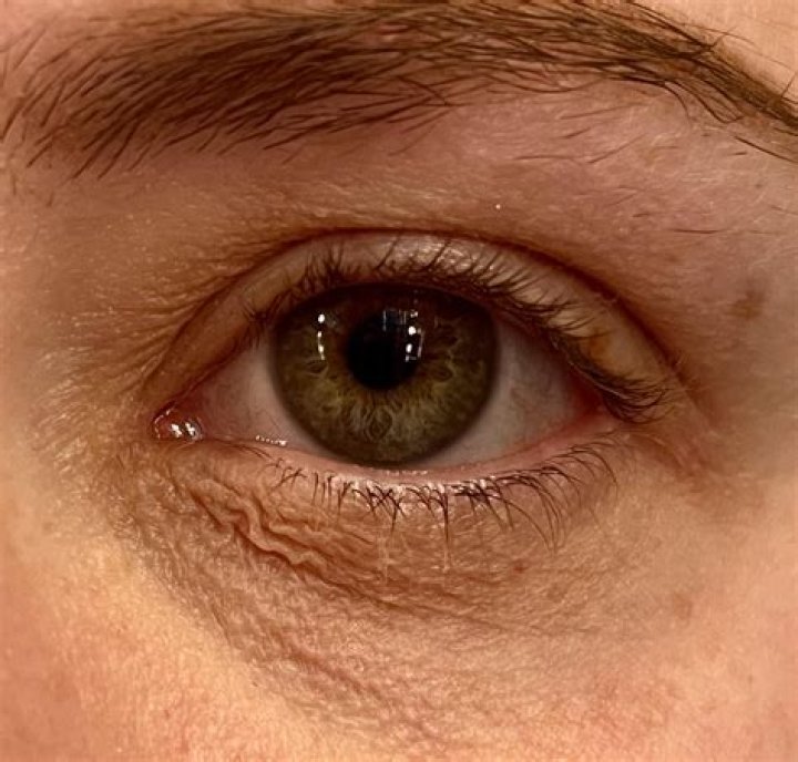 Why is the skin under my eye loose?