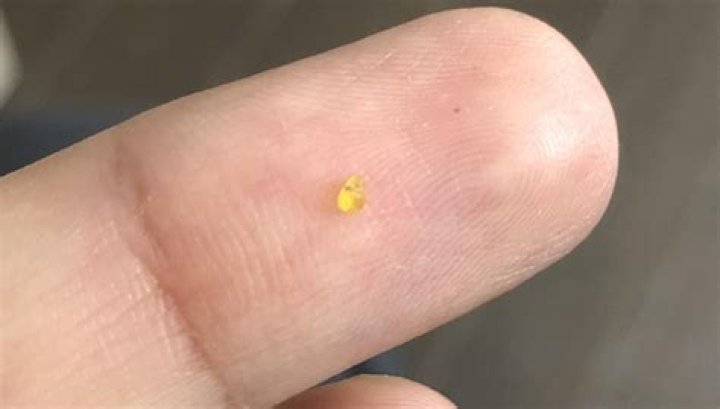 Why is yellow stuff coming out of my pee hole?