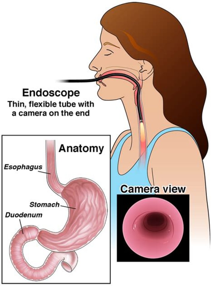 Why would they take a biopsy during an endoscopy?
