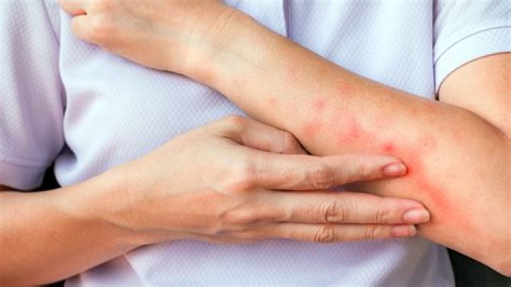 Why you shouldn't scratch mosquito bites?