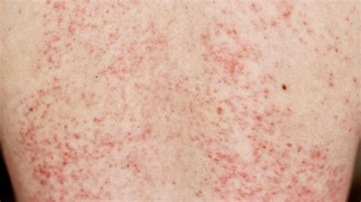 Will a rash go away on its own?