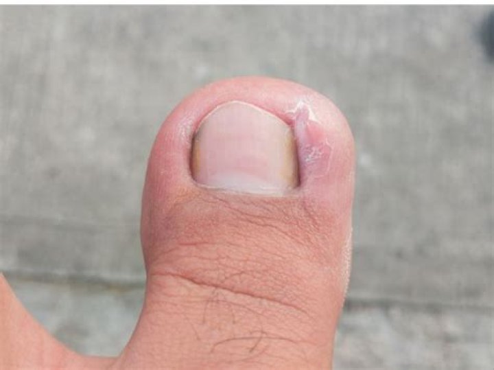 Will an ingrown toenail eventually grow out?