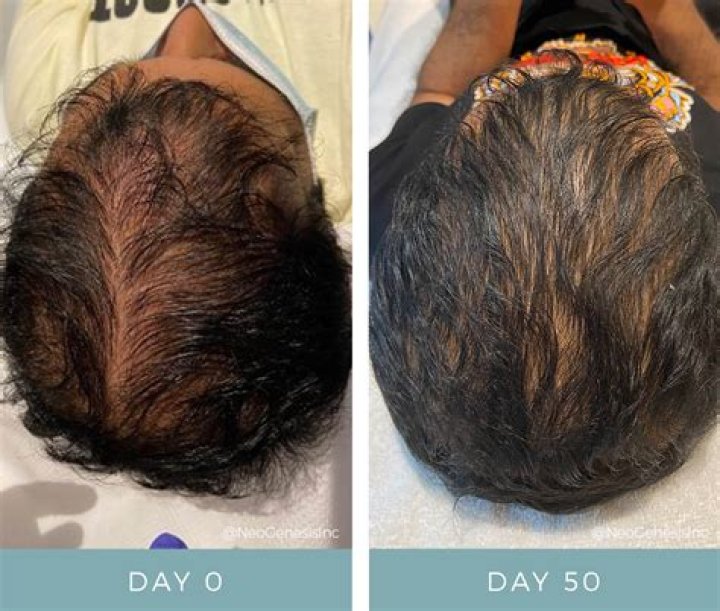 Will hair grow back after poor nutrition?