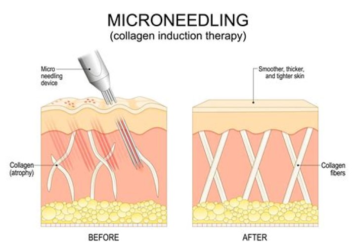 Will microneedling tighten skin?
