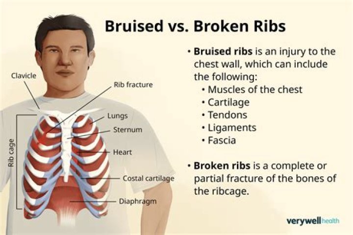 Will muscle relaxers help a broken rib?
