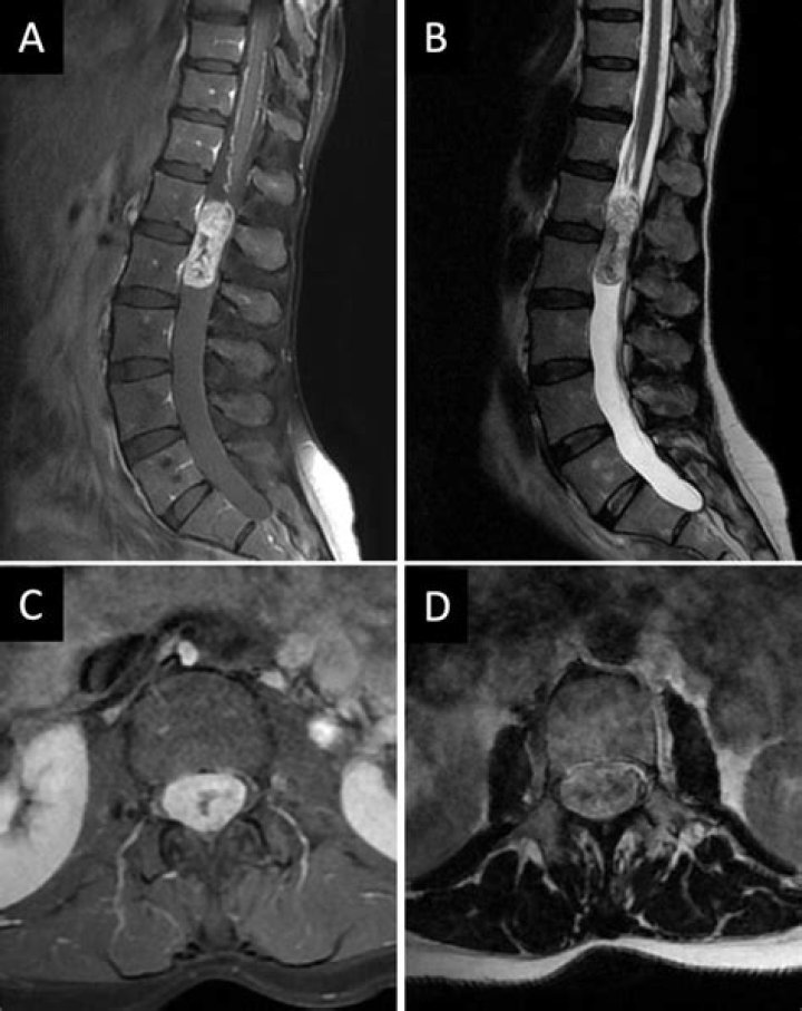 Would a spinal tumor show up on xray?